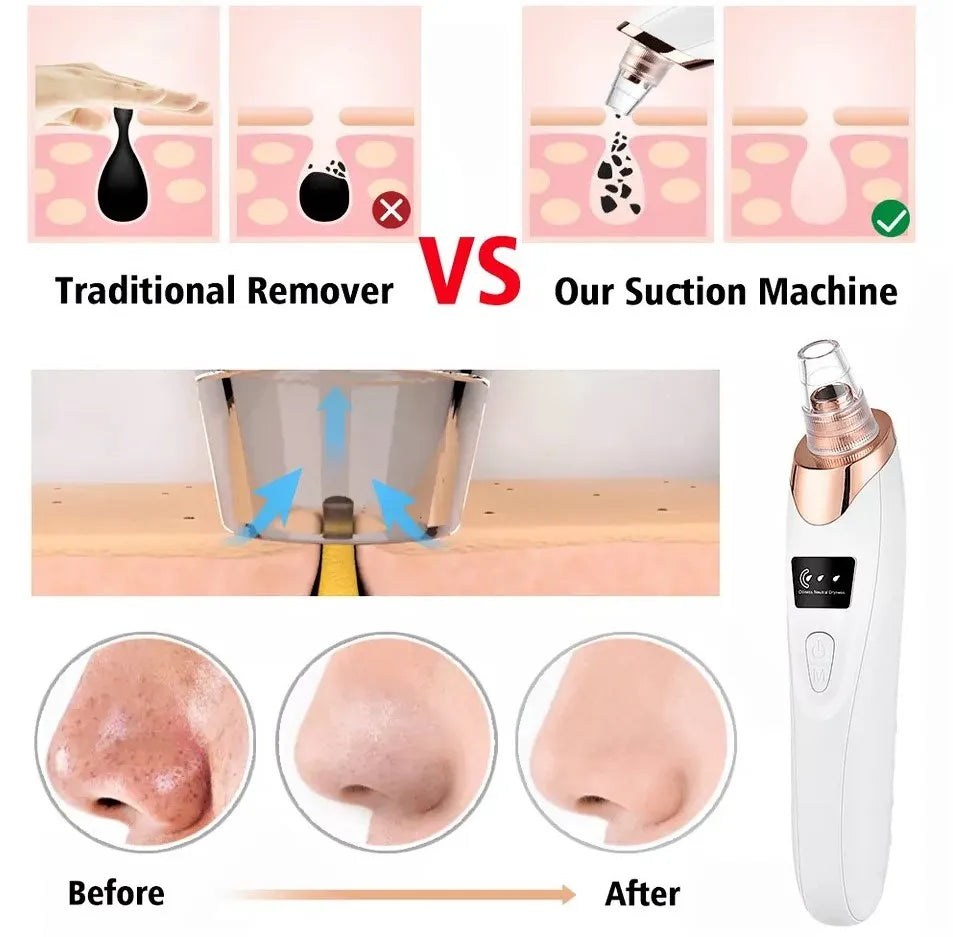 5-in-1 Blackhead Remover Machine – Rechargeable Face Vacuum Pore Cleaner with 5 Suction Heads